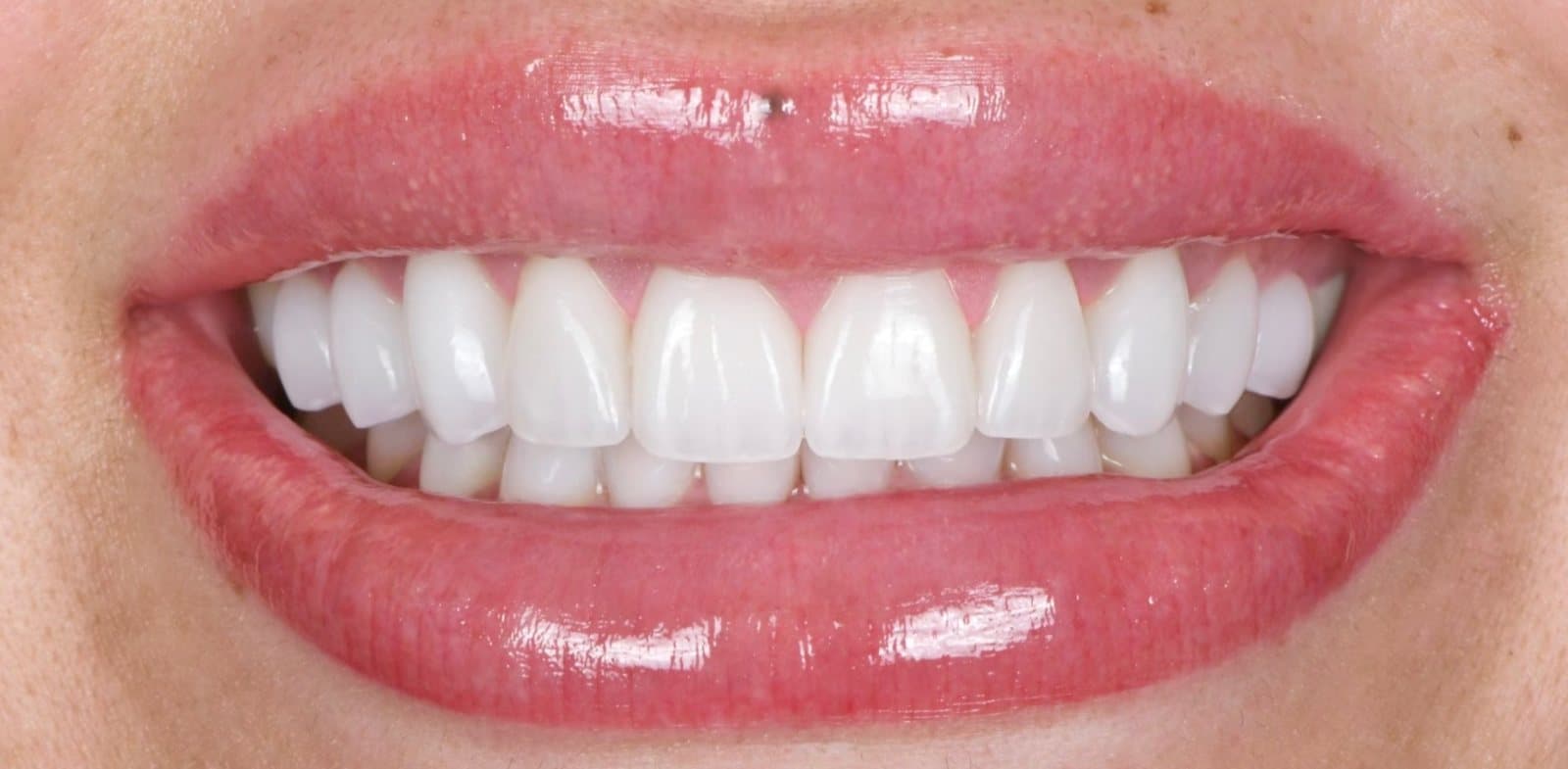 Sourire après la pose de facettes de porcelaine par Dr Ben Sabbah, cas 01