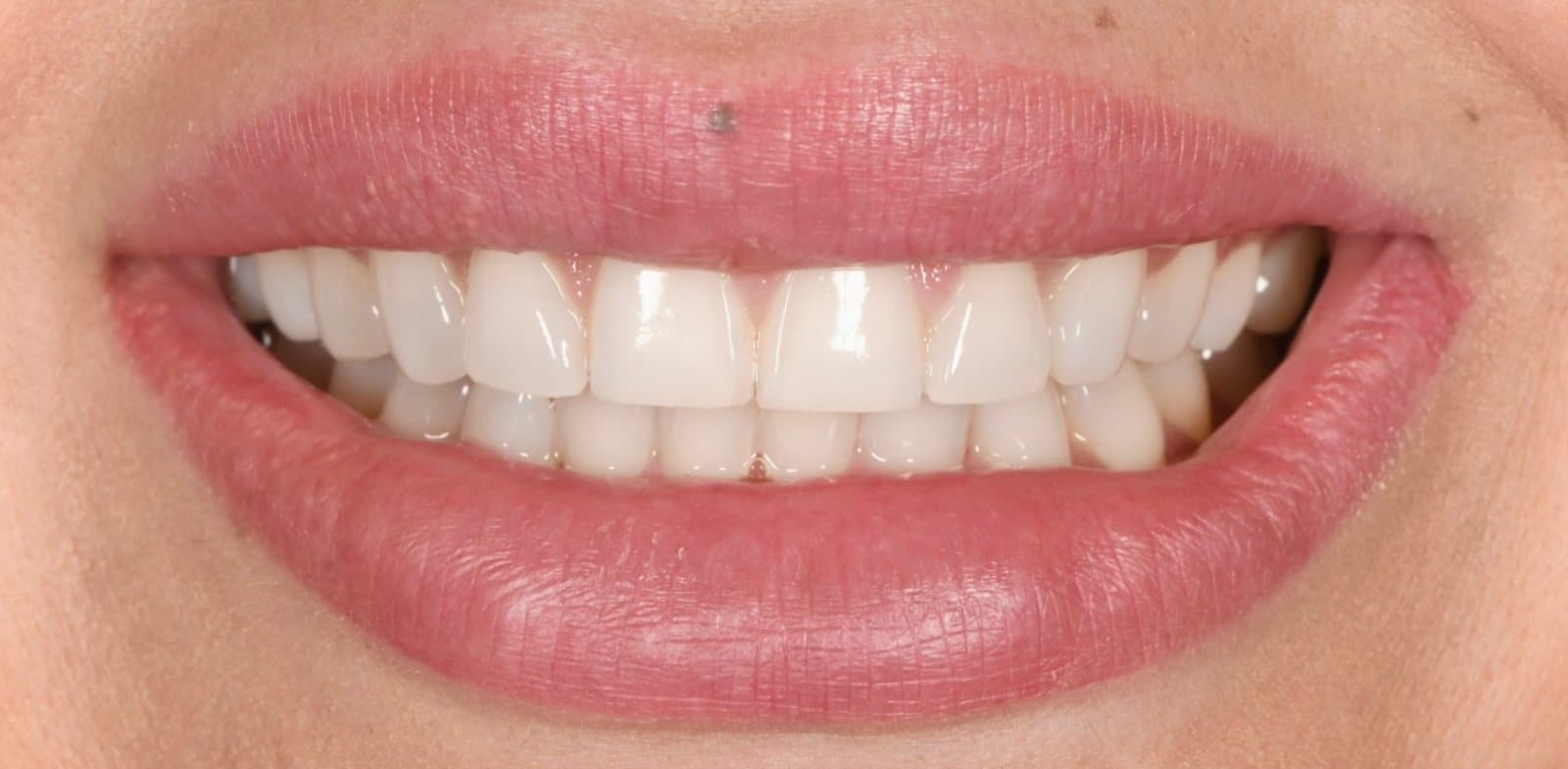 Sourire avant le traitement par facettes de porcelaine, cas 01