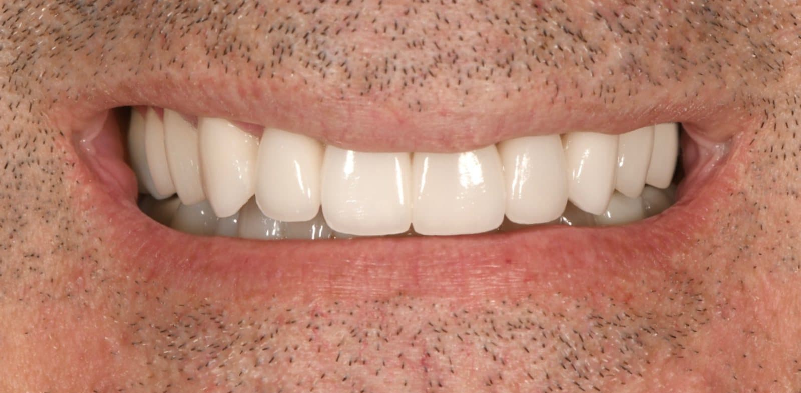 Sourire après la pose de facettes de porcelaine par Dr Ben Sabbah, cas 02