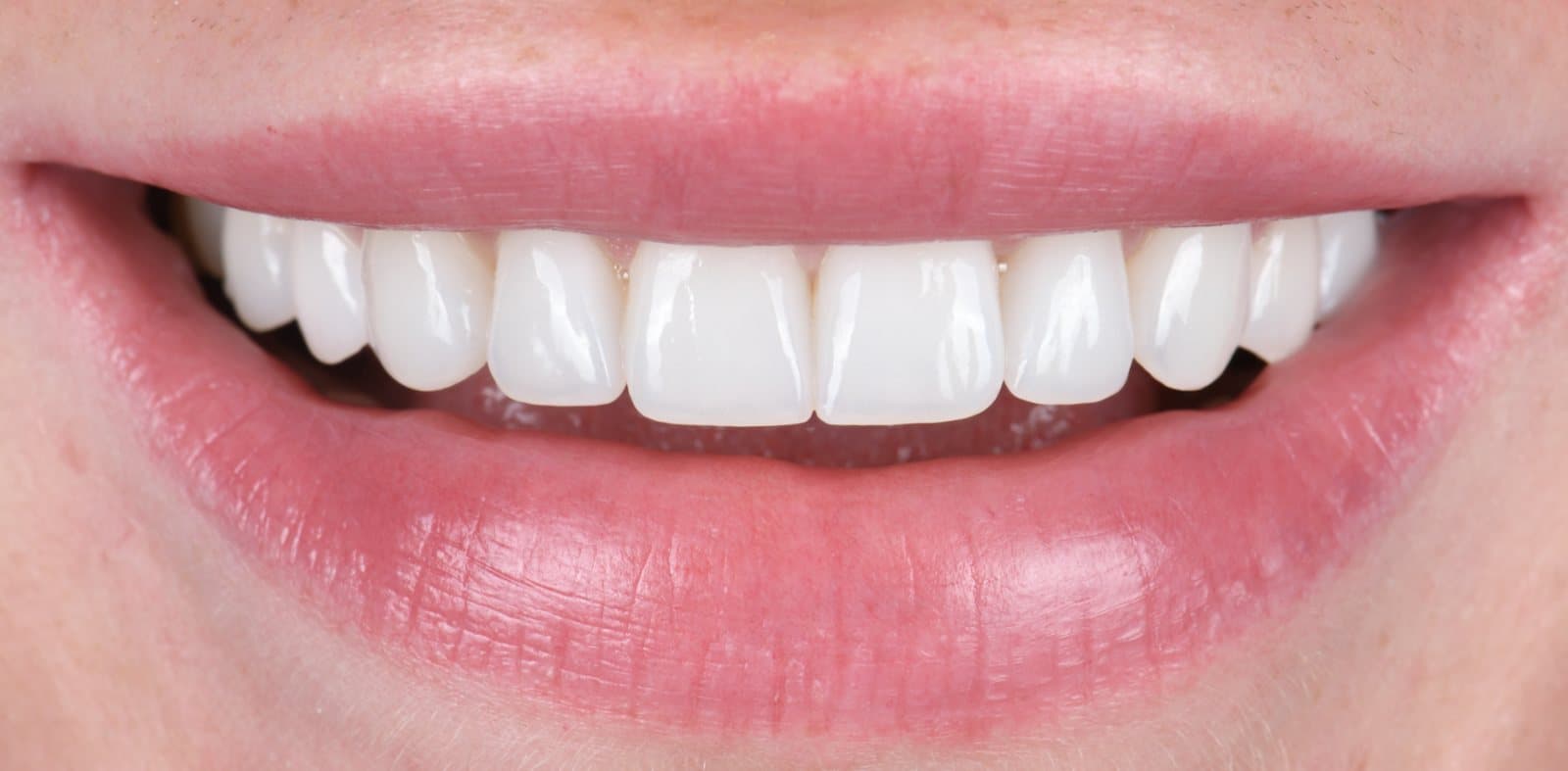 Sourire après la pose de facettes de porcelaine par Dr Ben Sabbah, cas 03