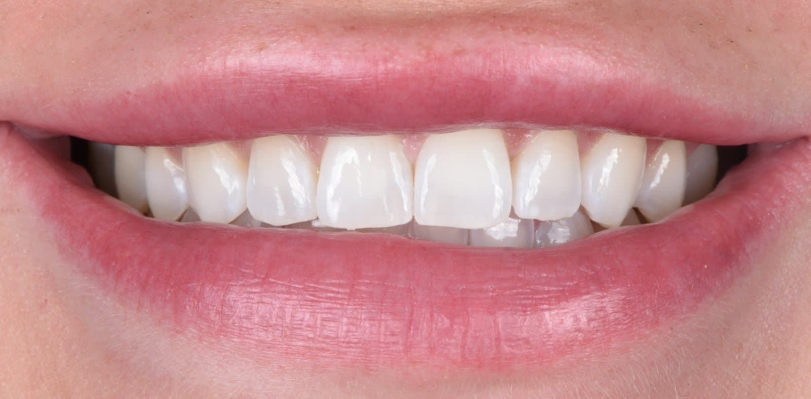 Sourire avant le traitement par facettes de porcelaine, cas 03
