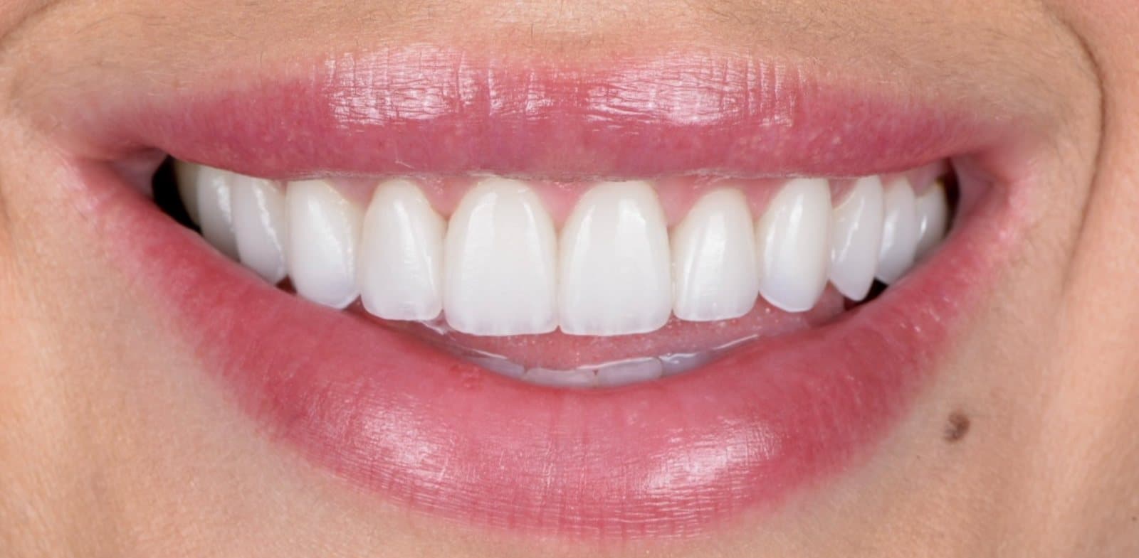 Sourire après la pose de facettes de porcelaine par Dr Ben Sabbah, cas 04