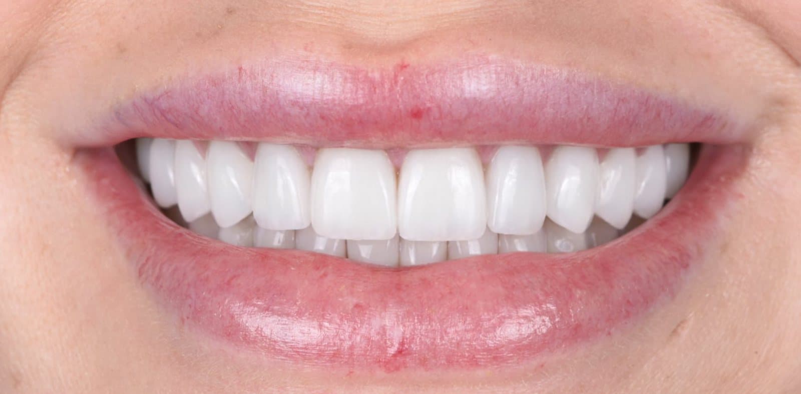 Sourire après la pose de facettes de porcelaine par Dr Ben Sabbah, cas 05